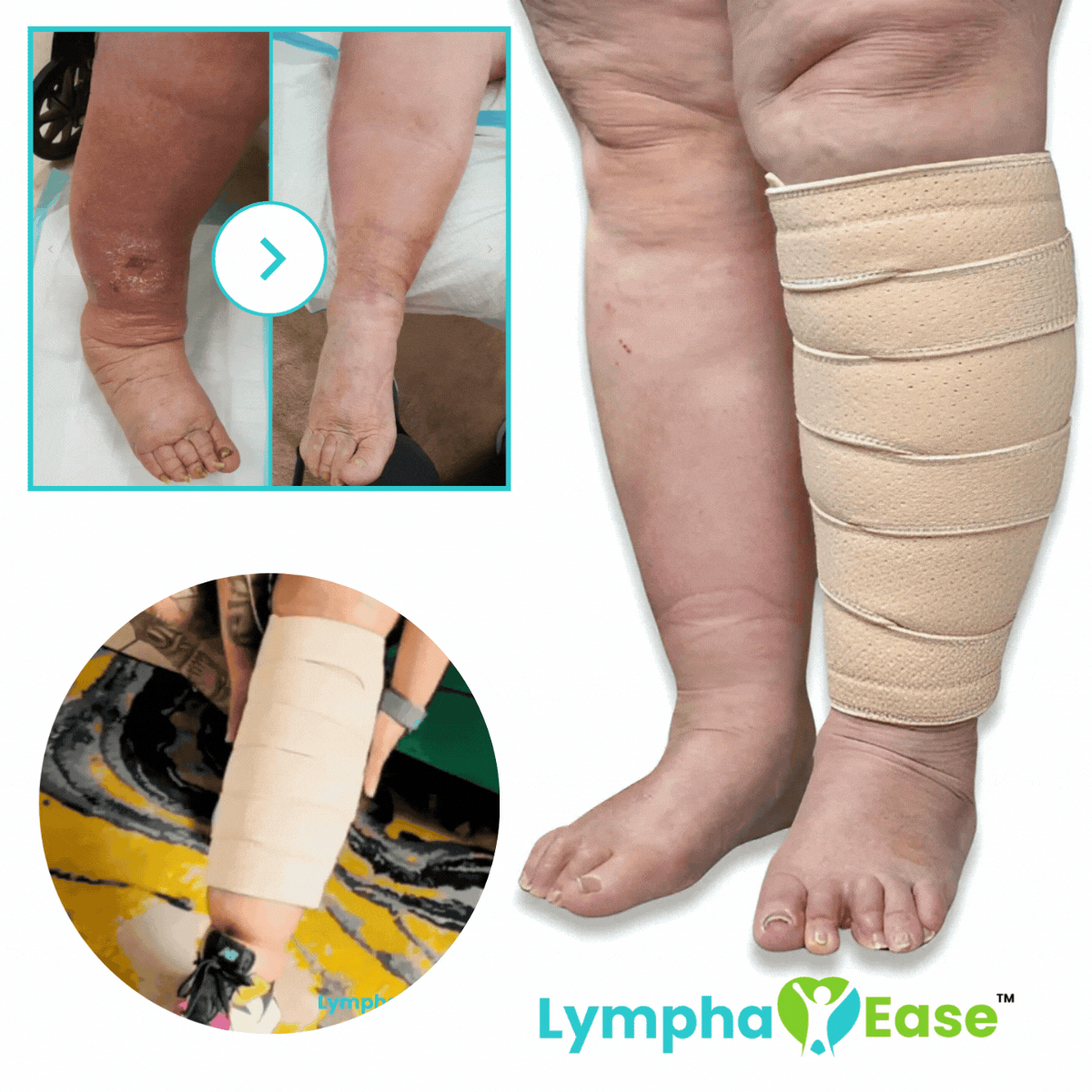 LymphaEase™ Compression Wraps | Discover a Life Without Swelling, Pain and Limits